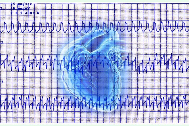Аритмия, кардиограмма