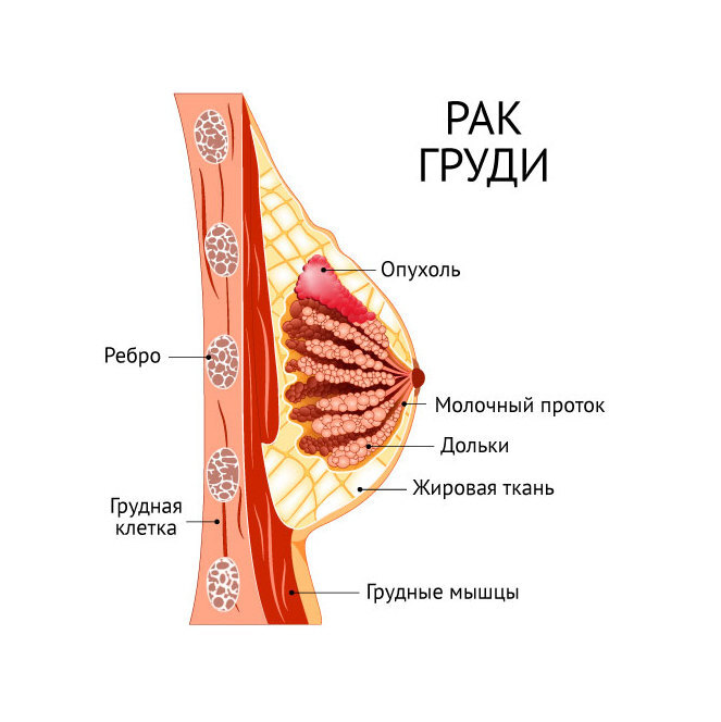 Онконасторожённость: что вам нужно знать о женских видах рака, чтобы не бояться