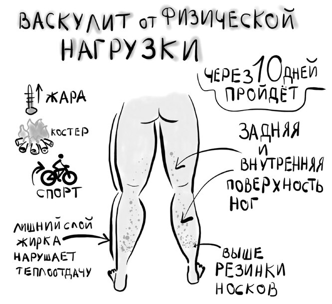 васкулит