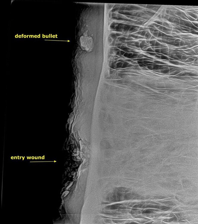 Рентген показал, что пуля застряла в кости