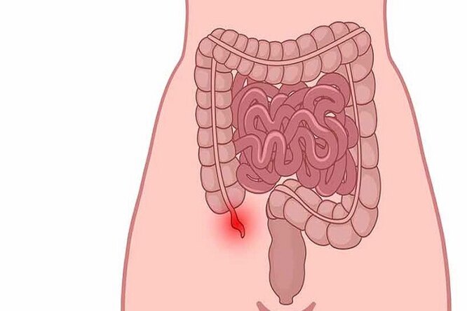 5 симптомов аппендицита, при которых нужно срочно вызвать скорую