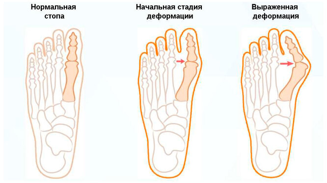 Вальгусная стопа: что делать, если вылезла косточка?